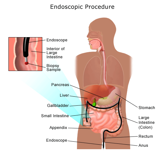 endoscopic procedure